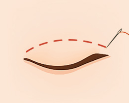 procedures03