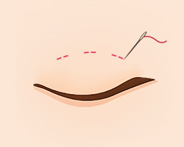 procedures03