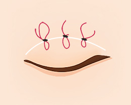 procedures02