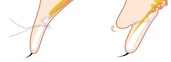 procedure