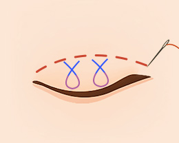 procedures03