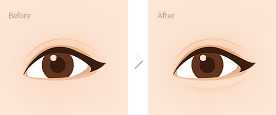 procedure