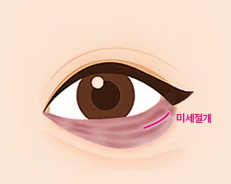 procedures02