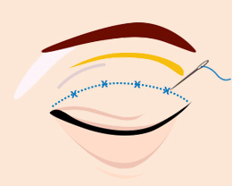 procedures03
