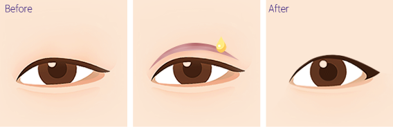 ű
