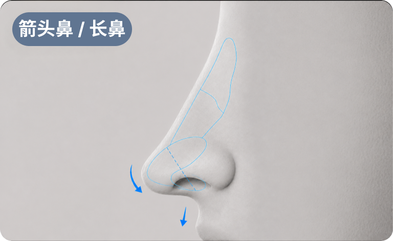 鹰钩鼻/长鼻类型精准分析