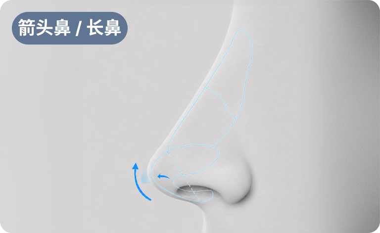 改善鼻部线条与比例