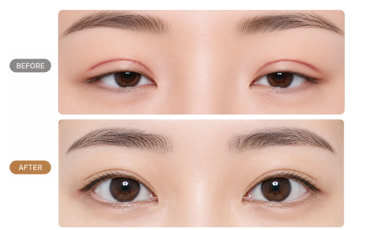 흉터가 심하게 남았거나 수술 전보다 눈이 작아보이는 경우