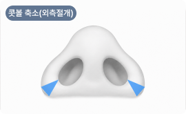 콧볼축소(외측절개)