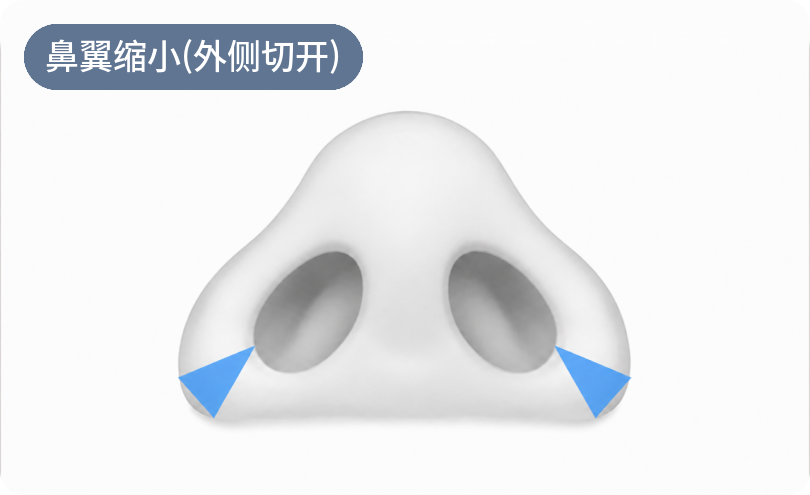 鼻翼缩小术 (外侧切开)