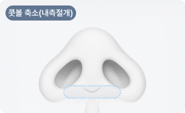 콧볼축소(내측절개)