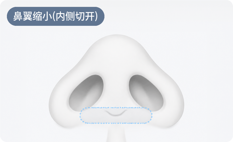 鼻翼缩小术 (内侧切开)