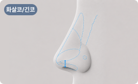 코끝 구조 교정