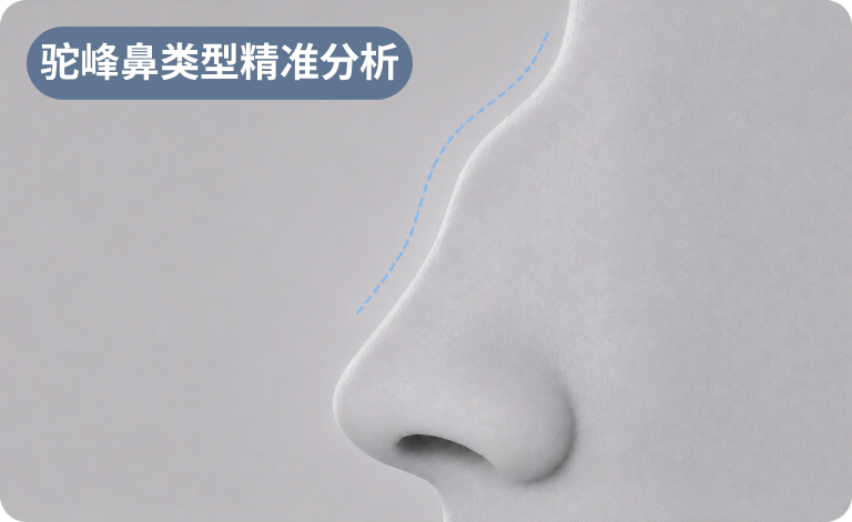驼峰鼻类型精准分析