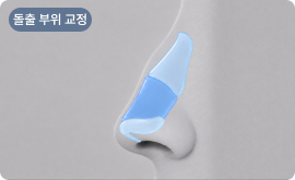 돌출 부위 교정