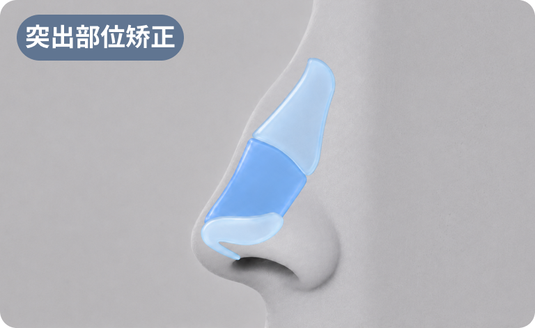 凸起驼峰矫正