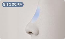 절개 후 삽입 공간 확보