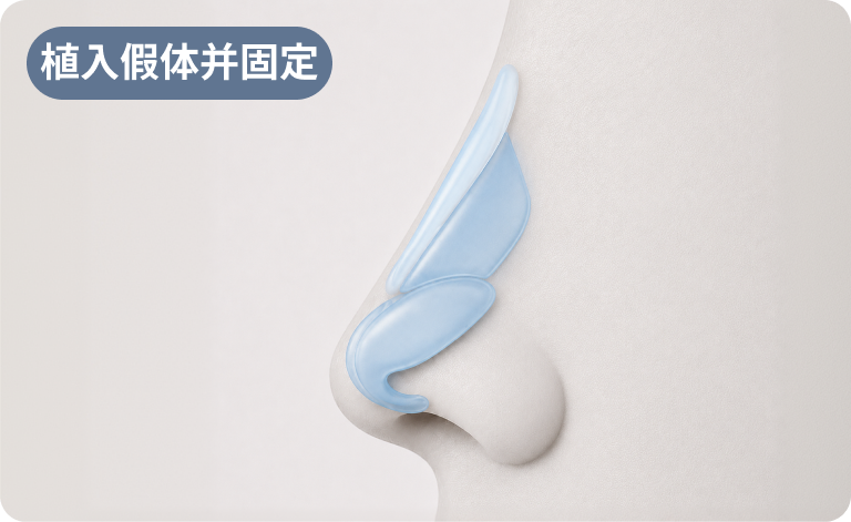 鼻尖调整及假体植入